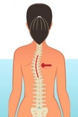 scoliosis